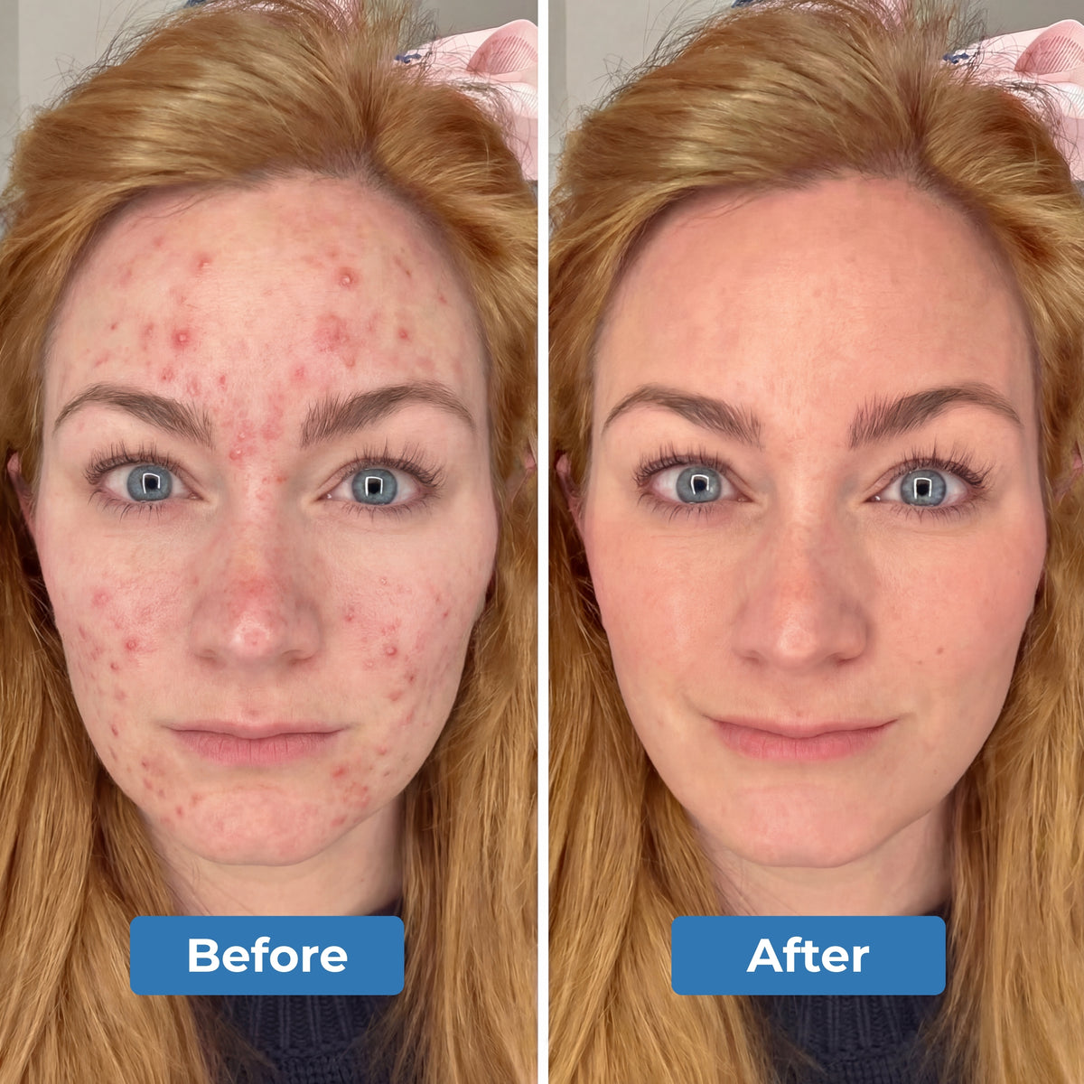 Red Light Therapy Mask